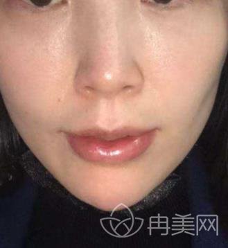郑州赵绛波案例分享,附唇腭裂整形真实效果图
