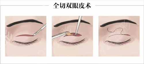 上海市华东医院整形科双眼皮案例