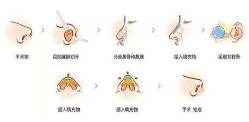 隆鼻手术案例前后