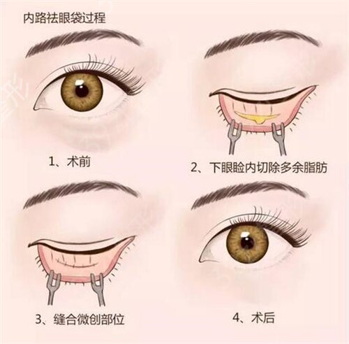 海南省眼科医院整形外科去眼袋案例：