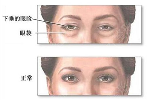 上海星和医疗美容门诊部外切祛眼袋案例