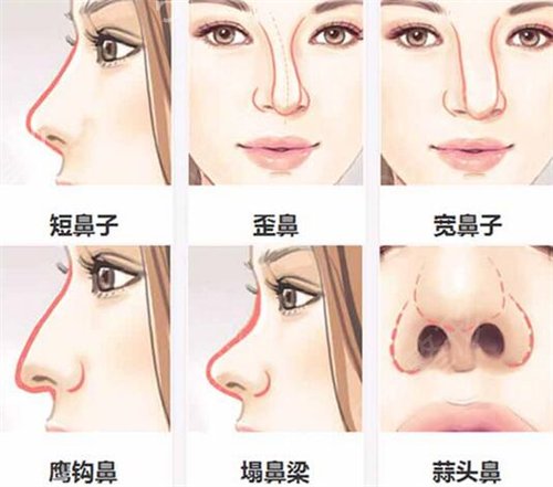 上海星和医疗美容门诊部鼻部整形案例
