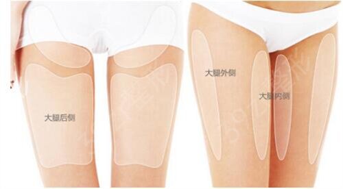 海南省人民医院整形外科大腿吸脂案例：