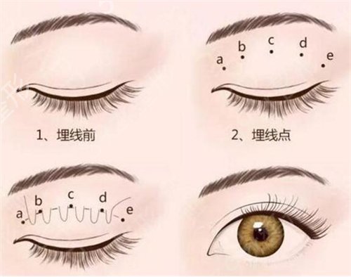 锦州医科大学附属第一医院整形双眼皮案例