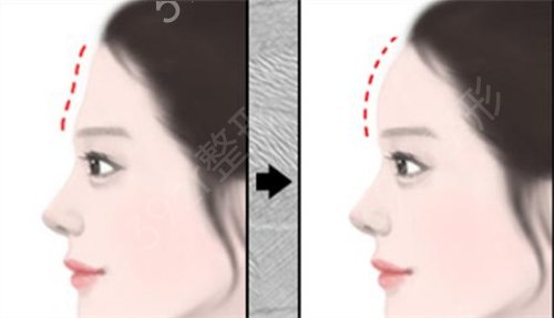 上海颜术高得医疗美容门诊部面部脂肪填充案例