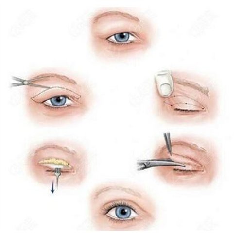 上海瑞金医院整形外科双眼皮案例