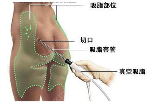 大腿抽脂对身体有危害吗?会反弹不?