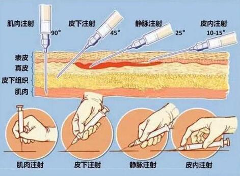 玻尿酸针价格多少钱一支?