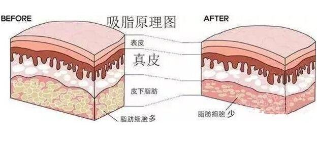 大腿抽脂什么价位?给个具体的数字