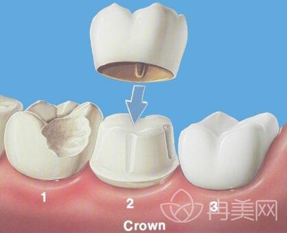 牙齿缺损怎么办?这几种状况告诉你怎样修复更正确