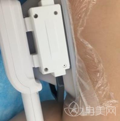 苏州美莱整形医院价格表新版来袭，附大腿吸脂术后日记