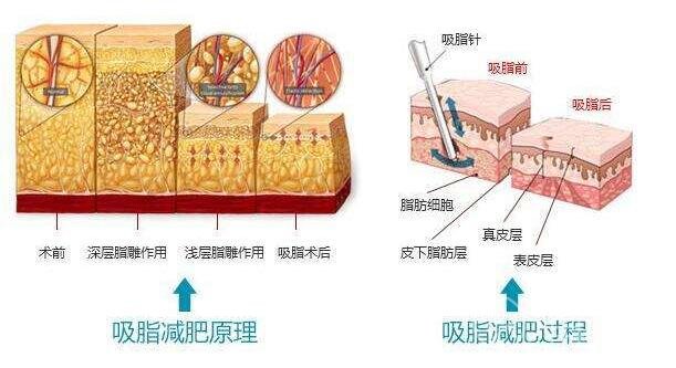 腰腹吸脂后多久才不痛?