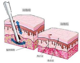 光纤溶脂多久*果佳？