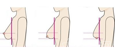 【干货】关于乳房下垂如何矫正?这四种方法你需要了解