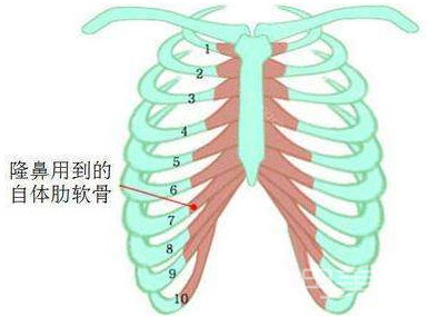 肋软骨隆鼻术后鼻头下移有哪些原因？如何进行修复？