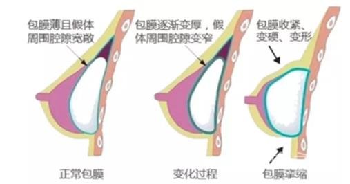 隆胸手术竟然存在这些你不知道的危害！