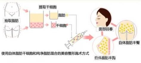 自体脂肪隆胸不仅有风险还有后遗症?整形需谨慎