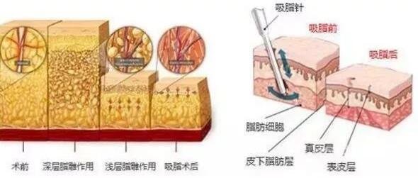 想要*吸脂减肥需要遵守以下原则，*健康塑形