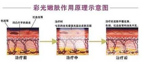 彩光嫩肤是什么?和光子嫩肤有什么区别?