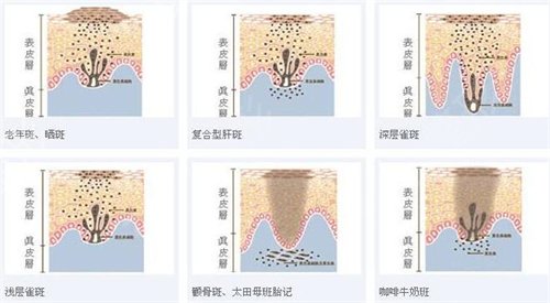 北海市人民医院整形科激光祛斑案例：