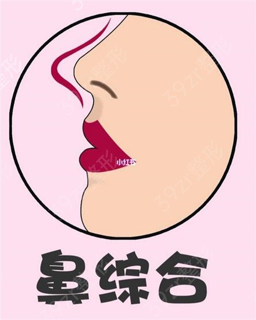 上海韩镜（原原辰）医疗美容医院隆鼻案例