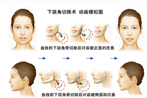 上海第八人民医院下颌角案例