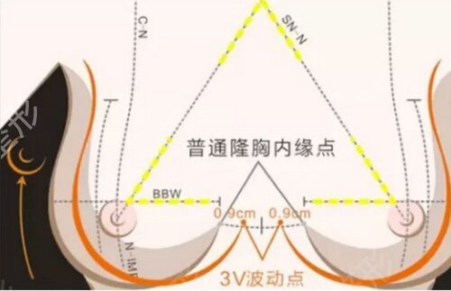 宝鸡市中心医院整形外科隆胸案例：