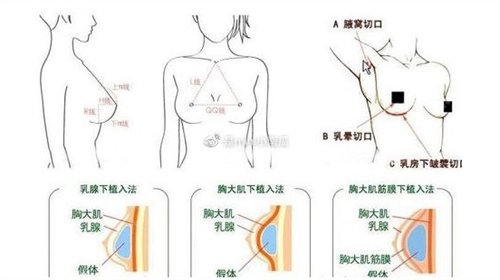 赣州附属医院整形美容科丰胸*果好吗？看价格表及案例