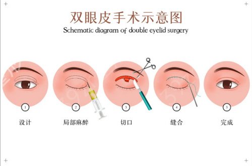 北京彤美刘风卓医生双眼皮失败修复案例：