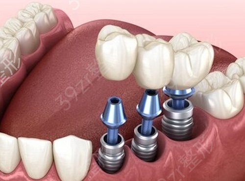 【案例】第一医院口腔科牙齿种植多少钱？三个月恢复记录|价格表
