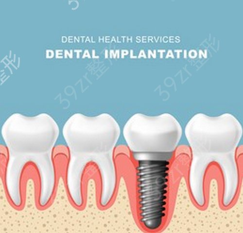 【案例】第一医院口腔科牙齿种植多少钱？三个月恢复记录|价格表