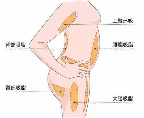 在广州星团医学美容做的全身吸脂减肥，从胖妈重回辣妈身材