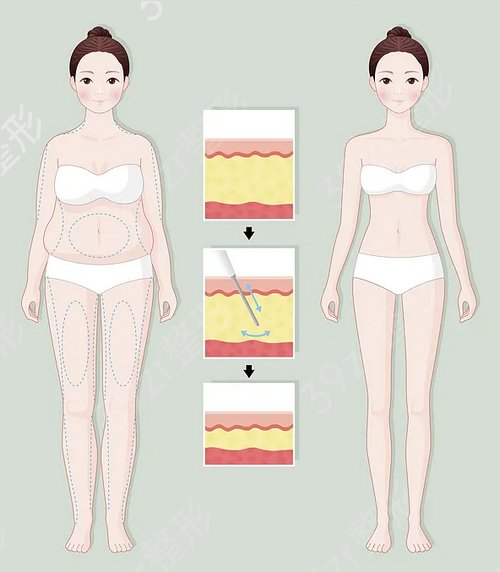 在广州星团医学美容做的全身吸脂减肥，从胖妈重回辣妈身材