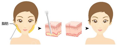 四川省医院抽脂瘦脸