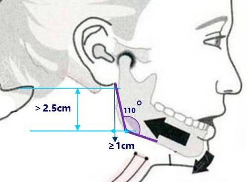 面部磨骨郭军、靳小雷、滕利医生优势在哪?案例图参考*果