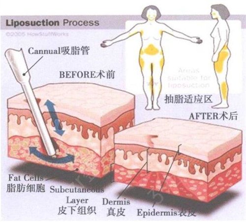 广东医科大学附属医院整形科怎么样？吸脂恢复两个月*果图!