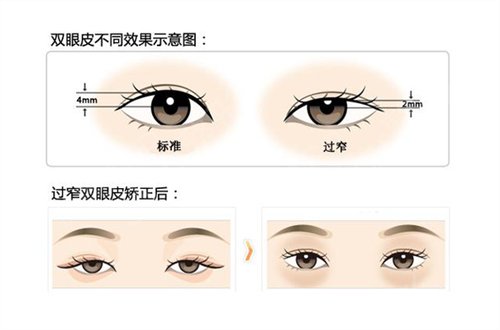 广西医科大学双眼皮很自然*果展示