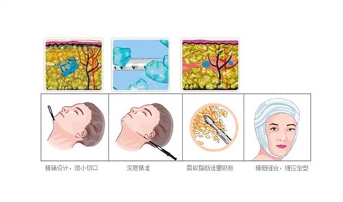 浙江省立同德医院整形外科面部吸脂+手臂吸脂案例~恢复照片