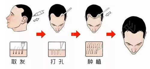 上海科发源医院植发价格是多少？附真实植发经历及收费明细