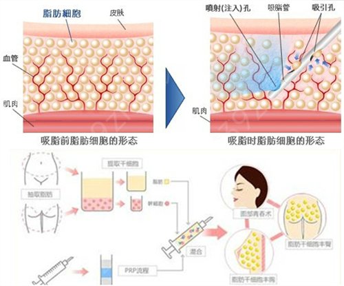 【图解】深圳北大医院大腿抽脂及恢复过程拍照记录