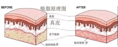 【图解】深圳北大医院大腿抽脂及恢复过程拍照记录