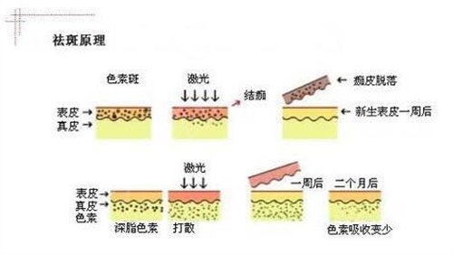 蝴蝶斑怎么去？