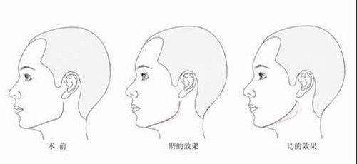 颧骨整形有风险吗?怎样可以降低颧骨整形的风险?