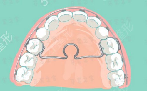 地包牙要怎样矫正?地包牙就是地包天吗?