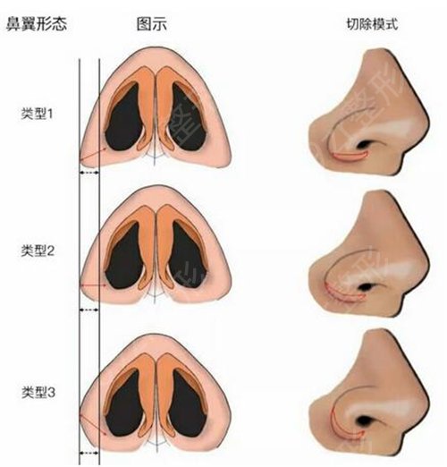 畸形鼻尖整形 鼻尖畸形整形要多少钱