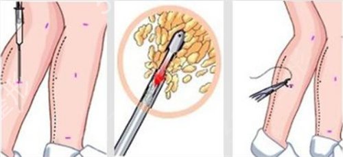 李国明主页_大腿吸脂两个月记录分享