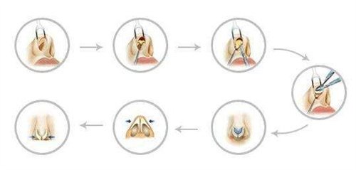 北京韩式耳软骨隆鼻，轻松拥有网红翘鼻