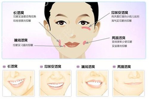 人造酒窝前后对比照片图片