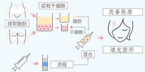 广州广美整形医院价格表抢先一看，附面部填充*果图