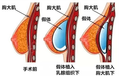 陕西省友谊医院医疗美容科价格表，附胡江波隆胸手术*果图